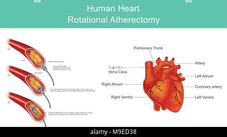 Athérectomie est une procédure qui permet de supprimer à partir de plaques d'Athérosclérose des artères malades. Les plaques d'athérome sont localisés dans l'une ou l'autre Illustration de Vecteur