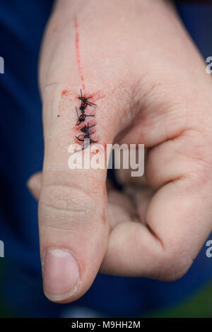 Close-up d'une blessure à l'aide de points de suture au pouce gauche sur la plaie. Banque D'Images