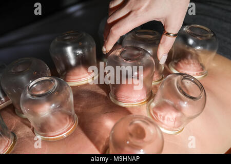 Femme détendue avec retour exposés après un traitement d'une fire cupping acupuncture thérapeute. selective focus Banque D'Images