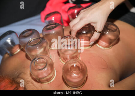 Femme détendue avec retour exposés après un traitement d'une fire cupping acupuncture thérapeute. selective focus Banque D'Images