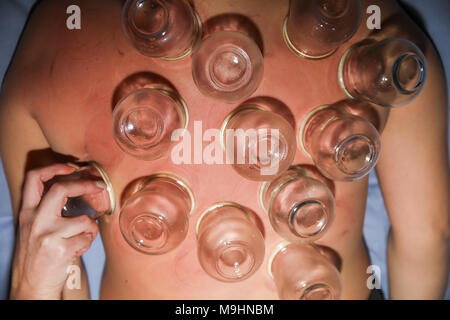 Femme détendue avec retour exposés après un traitement d'une fire cupping acupuncture thérapeute. selective focus Banque D'Images