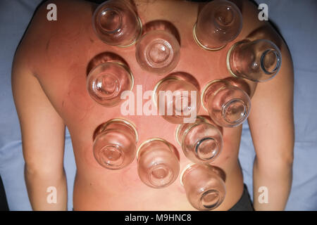 Femme détendue avec retour exposés après un traitement d'une fire cupping acupuncture thérapeute. selective focus Banque D'Images