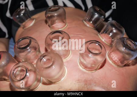 Femme détendue avec retour exposés après un traitement d'une fire cupping acupuncture thérapeute. selective focus Banque D'Images