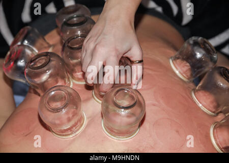 Femme détendue avec retour exposés après un traitement d'une fire cupping acupuncture thérapeute. selective focus Banque D'Images