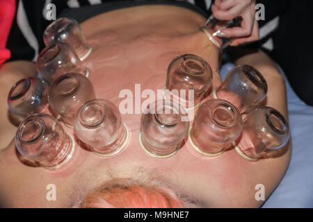 Femme détendue avec retour exposés après un traitement d'une fire cupping acupuncture thérapeute. selective focus Banque D'Images