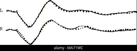 . Effets du traitement phonétique et sur la pertinence de stimulation de la réponse évoquée auditive. . CV CV. C. L Banque D'Images