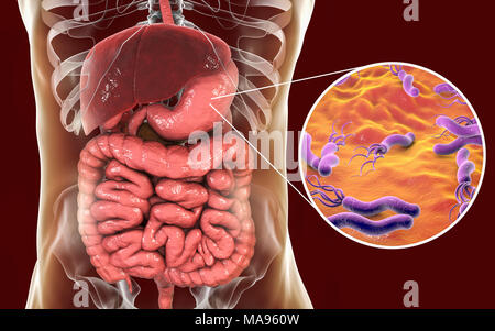 L'Helicobacter pylori. Illustration d'ordinateur d'Helicobacter pylori les bactéries dans un estomac humain. Anciennement connu sous le nom de Campylobacter pyloridis, ce sont en forme de spirale les bactéries Gram-négatives. Les flagelles de terminal (sèche-comme les structures) sont utilisés pour la locomotion. Colonies de H. pylori sont trouvés dans le mucus de l'estomac. Ils causent une gastrite, et sont aussi la cause la plus fréquente d'ulcères de l'estomac. H. pylori peut également être une cause ou un co-facteur de cancer de l'estomac, comme sa présence augmente le risque de développer des tumeurs de l'estomac. Banque D'Images