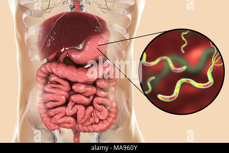 L'Helicobacter pylori. Illustration d'ordinateur d'Helicobacter pylori les bactéries dans un estomac humain. Anciennement connu sous le nom de Campylobacter pyloridis, ce sont en forme de spirale les bactéries Gram-négatives. Les flagelles de terminal (sèche-comme les structures) sont utilisés pour la locomotion. Colonies de H. pylori sont trouvés dans le mucus de l'estomac. Ils causent une gastrite, et sont aussi la cause la plus fréquente d'ulcères de l'estomac. H. pylori peut également être une cause ou un co-facteur de cancer de l'estomac, comme sa présence augmente le risque de développer des tumeurs de l'estomac. Banque D'Images