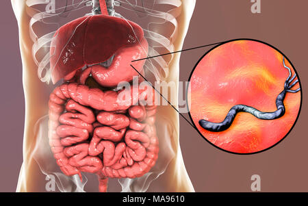 L'Helicobacter pylori. Illustration d'ordinateur d'Helicobacter pylori les bactéries dans un estomac humain. Anciennement connu sous le nom de Campylobacter pyloridis, ce sont en forme de spirale les bactéries Gram-négatives. Les flagelles de terminal (sèche-comme les structures) sont utilisés pour la locomotion. Colonies de H. pylori sont trouvés dans le mucus de l'estomac. Ils causent une gastrite, et sont aussi la cause la plus fréquente d'ulcères de l'estomac. H. pylori peut également être une cause ou un co-facteur de cancer de l'estomac, comme sa présence augmente le risque de développer des tumeurs de l'estomac. Banque D'Images