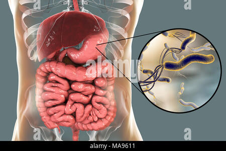 L'Helicobacter pylori. Illustration d'ordinateur d'Helicobacter pylori les bactéries dans un estomac humain. Anciennement connu sous le nom de Campylobacter pyloridis, ce sont en forme de spirale les bactéries Gram-négatives. Les flagelles de terminal (sèche-comme les structures) sont utilisés pour la locomotion. Colonies de H. pylori sont trouvés dans le mucus de l'estomac. Ils causent une gastrite, et sont aussi la cause la plus fréquente d'ulcères de l'estomac. H. pylori peut également être une cause ou un co-facteur de cancer de l'estomac, comme sa présence augmente le risque de développer des tumeurs de l'estomac. Banque D'Images