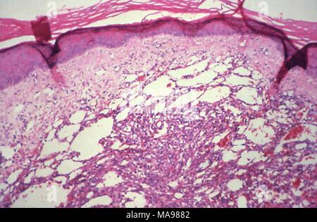 Sarcome de Kaposi a révélé à moyen grossissement photomicrographie de une biopsie cutanée, 1981. Image courtoisie Centres for Disease Control (CDC) / Dr Steve Kraus. () Banque D'Images