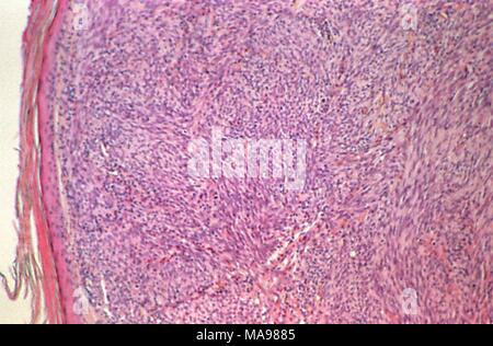 Les changements de Cytoarchitectural sarcome de Kaposi révélé dans la photomicrographie d'une biopsie de peau, 1981. Image courtoisie Centres for Disease Control (CDC) / Dr Steve Kraus. () Banque D'Images