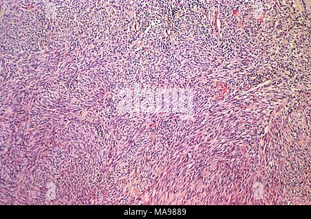 Cytoarchitectural des signes de la maladie de Kaposi révélé dans la photomicrographie d'une biopsie de peau, 1980. Image courtoisie Centres for Disease Control (CDC) / Dr Steve Kraus. () Banque D'Images