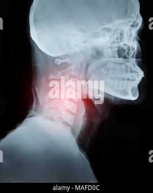 X-ray image les détails de cou et douleur de la Red Zone. Banque D'Images