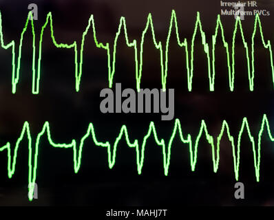 Un électrocardiogramme montrant la tachycardie ventriculaire en lignes vert néon contre le fond noir d'un moniteur. Banque D'Images