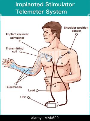 Stimulateur implanté système télémètre Illustration de Vecteur