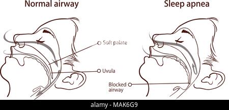 SYNDROME D'APNÉE DU SOMMEIL Illustration de Vecteur