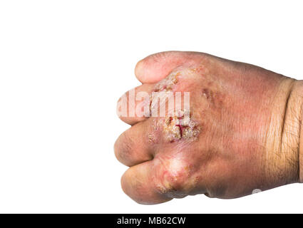 Close up de l'eczéma ou de psoriasis sur la peau à la main avec des plaies ouvertes, Peel et crust isolé sur blanc. Copier l'espace. Banque D'Images