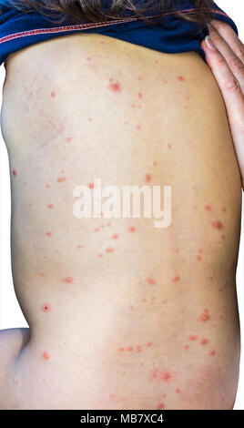 Gros plan du virus de la varicelle La varicelle ou éruption vésiculeuse et bulle sur dos du bébé avec des mères la main. Isolé sur blanc. Banque D'Images