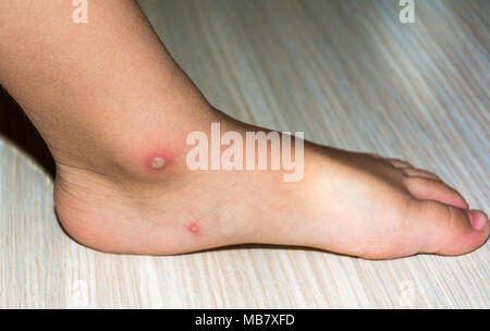 Gros plan du virus de la varicelle ou la varicelle de l'enfant bulle éruption sur la jambe ou le pied. Concept de dermatologie. Banque D'Images