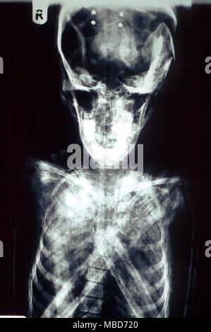 X-ray de crâne de momie de la période ptolémaïque. La momie est celle d'une jeune fille qui est morte d'un accident dans lequel sa tête a été écrasée, et ses cuisses se sont enfoncés dans le bassin. Musée du Château Cliffe en Keighley Banque D'Images