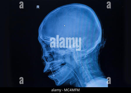 Film x-ray du crâne et de la colonne cervicale vue latérale. Banque D'Images