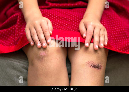 Close-up of little girl holding meurtri son genou endommagé blessé avec ses mains Banque D'Images