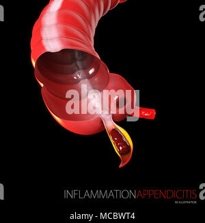 3D illustration de l'inflammation l'appendicite, l'anatomie humaine noir isolé Banque D'Images