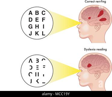 Vector illustration médicale des symptômes de la dyslexie Illustration de Vecteur