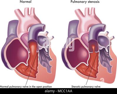 Une illustration d'un coeur humain avec la valve pulmonaire normale et un cœur avec une valve pulmonaire sténotique Illustration de Vecteur