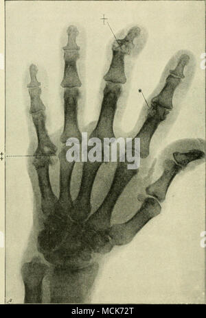 . Fig. 8.-La radiographie de la main d'un patient Goutteux. À l'endroit indiqué par l'astérisque, les tophi goutteux sont considérés comme des foyers translucide ; au poignard, exostoses semblables à des nœuds d'erden- Ileb ; au niveau du double dagger, subluxation dans le joint à la base du petit doigt. Banque D'Images