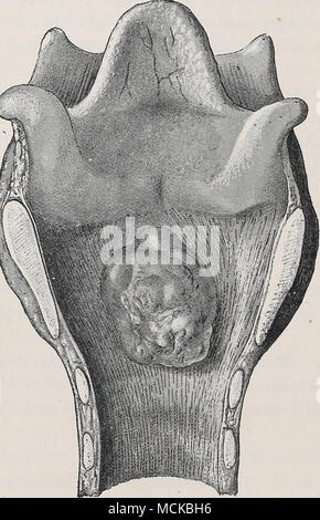. Fig. 170.- forme sessile des polypus laryngé. La bronchite. Les maladies des bronches chez les bovins de l'évidence de très différents personnages, selon la nature de la cause première, pour qui Banque D'Images