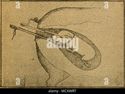 . N° de la plaque 7. La coupe ci-dessus montre comment gérer les cas très difficiles, où le cochon est si grande qu'aucune d'autres instruments, et peut-être ni l'un des nôtres, vous donnera la délivrance. Dans ce cas, nous n'avons jamais manqué lors de l'utilisation des deux pinces, le transporteur à chaîne de tirage et les lames au travail et diminuer la tête. Banque D'Images