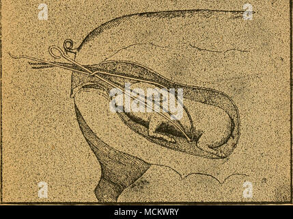 . La planche no 5. Montre la manière d'ajuster notre chaîne de valeur inestimable car- rying forceps n° 4. Dans de nombreux cas, le cochon est l'ensemble trouvé- tulé si bas derrière le bassin que les vieilles pinces charnières ne sera pas toucher. Dans ce cas, c'est le seul instrument qui va atteindre le cochon, et ce uniquement dans la manière suivante : un bras est immobilisé pendant que l'autre long et correctement bras courbé est exécuté loin en arrière et vers le bas jusqu'à ce qu'il peut être porté sous le cochon, dessin le cordon autour d'une boucle, quand le porc peuvent être soulevées. Banque D'Images