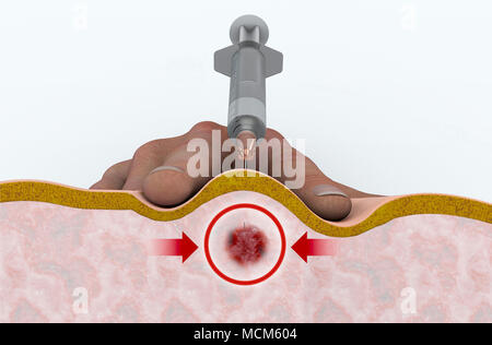 Un point de déclenchement injection est un procédé visant à réduire ou à soulager les maux de dos causés par des points de déclenchement. L'injection intramusculaire Banque D'Images