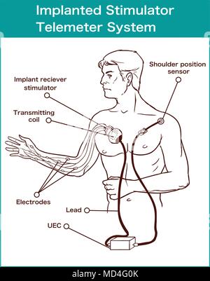 Stimulateur implanté système télémètre Illustration de Vecteur