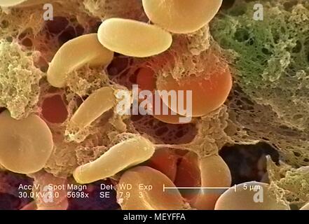 Globules rouges dans une matrice fibrineuse sur la surface luminale d'un cathéter vasculaire à demeure dans la microscopie électronique à balayage (MEB) libre de droit avec la permission de centres de contrôle des maladies (CDC) / Janice Haney Carr, 2005. Remarque : l'image a été colorisée numériquement à l'aide d'un processus moderne. Les couleurs peuvent ne pas être exacts à l'autre. () Banque D'Images
