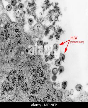 Présence de formes matures du virus de l'immunodéficience humaine (VIH) dans un échantillon de tissu a révélé le caractère fortement amplifiés par transmission (TEM) micrographiques de droit, 1983. Image courtoisie Centres for Disease Control (CDC). () Banque D'Images