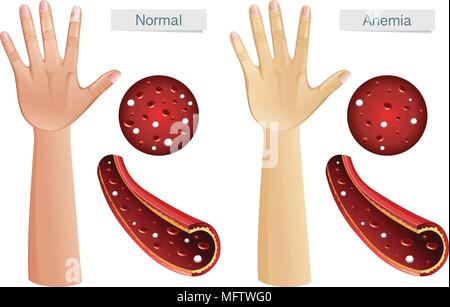 L'anatomie humaine de l'anémie vecteur illustration Illustration de Vecteur