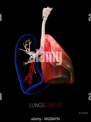 Le cancer du poumon, épanchement pleural 3d illustration noir isolé. Banque D'Images