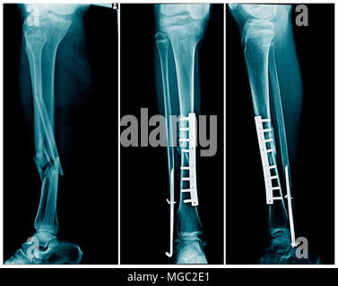 X-ray fracture de la jambe avec fixation interne après l'opération de l'os du tibia Banque D'Images