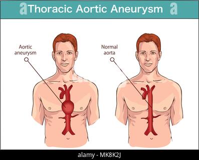 Types de l'anévrisme de l'aorte aorte normale. et élargi les navires. Diagramme vectoriel Illustration de Vecteur