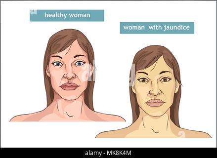 La comparaison entre la peau normale et le jaunissement de la Jaunisse Illustration de Vecteur