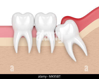 Le rendu 3D de la sagesse d'impaction mésiale avec la péricoronarite. Concept de différents types de problèmes de dents de sagesse. Banque D'Images