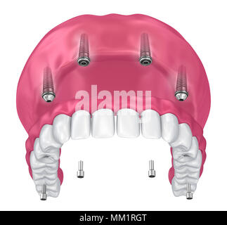 Pour Prothèse hybride être assis sur implants pièces jointes. 3D illustration Banque D'Images