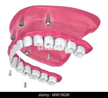 Pour Prothèse hybride être assis sur implants pièces jointes. 3D illustration Banque D'Images