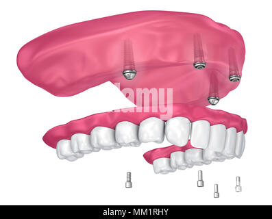 Pour Prothèse hybride être assis sur implants pièces jointes. 3D illustration Banque D'Images