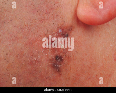 Mélanome maligna melanoma sur la joue gauche. Banque D'Images