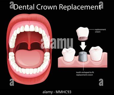 Les droits de l'embouchure de la couronne dentaire illustration de remplacement Illustration de Vecteur