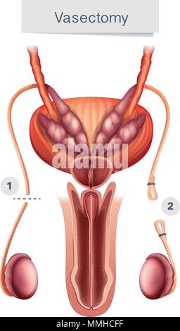 L'anatomie humaine de la vasectomie sur fond blanc illustration Illustration de Vecteur